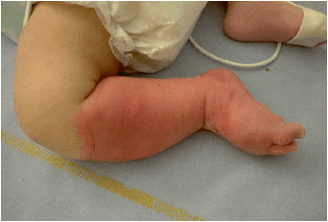 Éruption cutanée fébrile de l'enfant | Pas à Pas en Pédiatrie